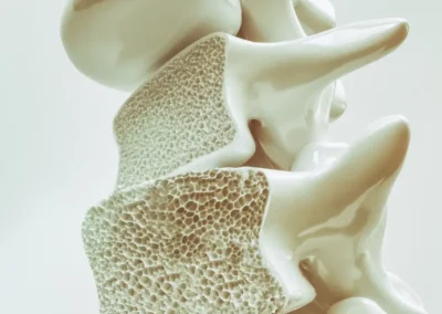 EJERCICIO Y OSTEOPOROSIS: ACTIVA-T